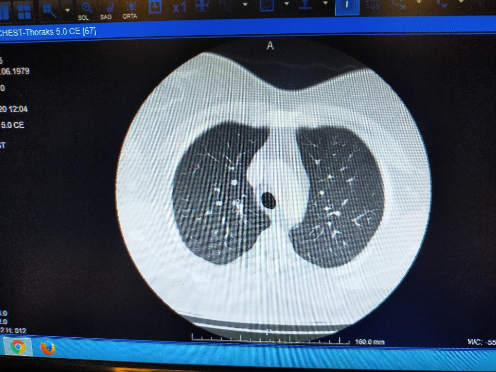 Korona virüse yakalanan hastaların ciğerlerindeki dehşet veren görüntü