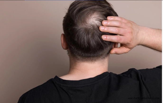 Erkeklere müjde.. Kelliğin ilacı bulundu