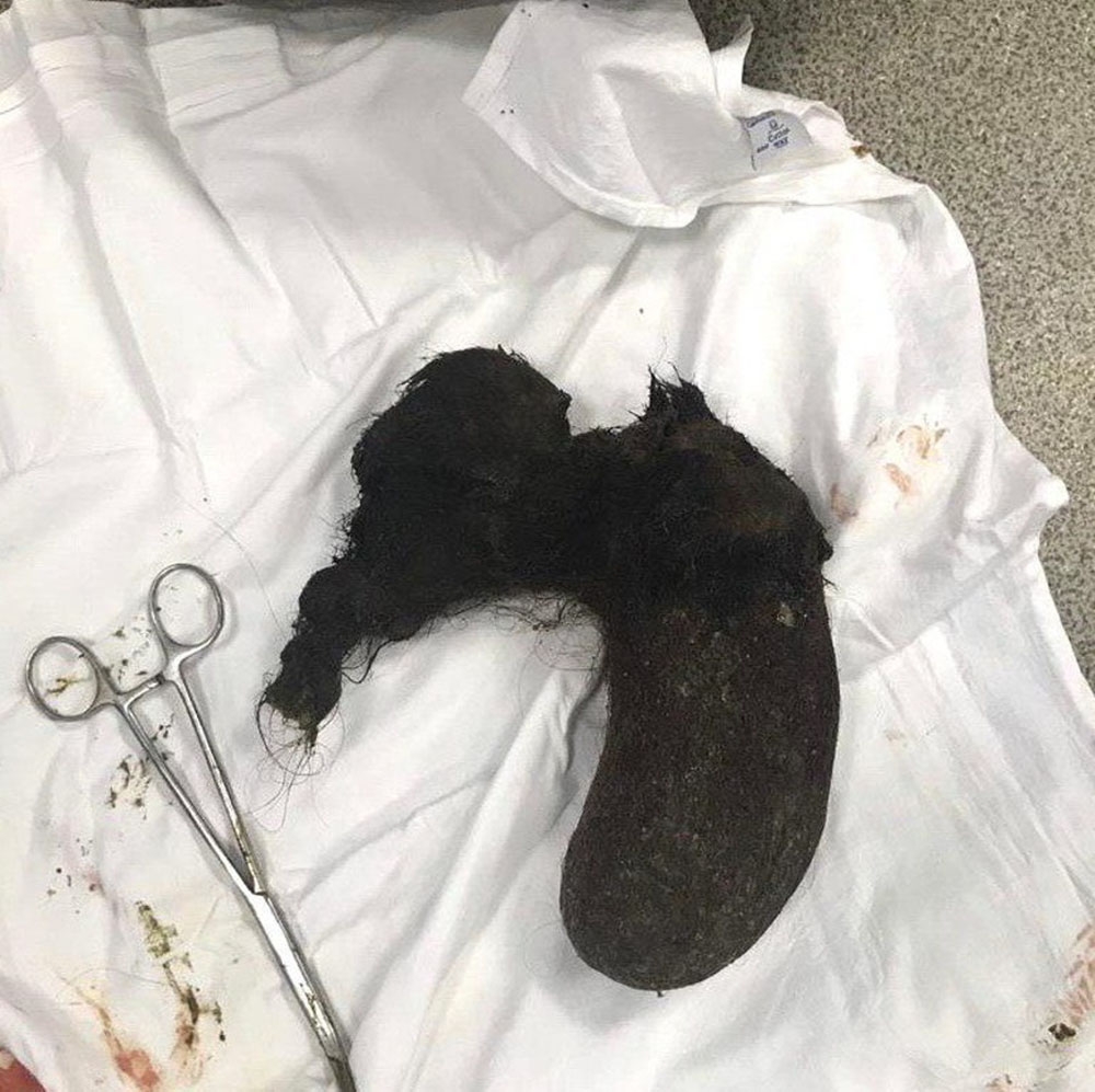 10 Yıl Boyunca Yediği Saçları Midesinden Çıkarıldı