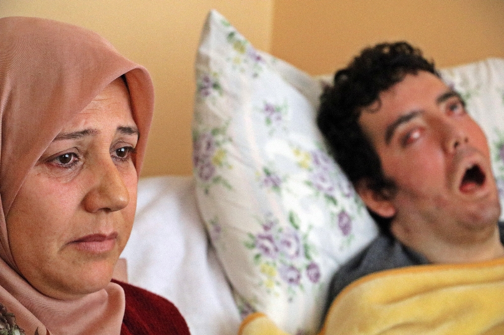 6 yıldır gözlerini kırpamıyor, kan çanağına dönen gözleri bantla kapatılıyor