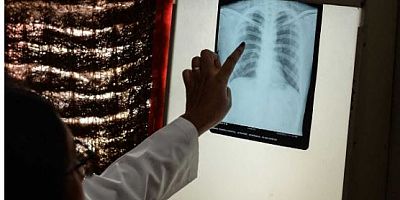 Akciğer kanserinin erken belirtileri olabilecek 9 belirti