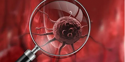 Aspirin, kanser yayılmasını engelleyebilir mi? 