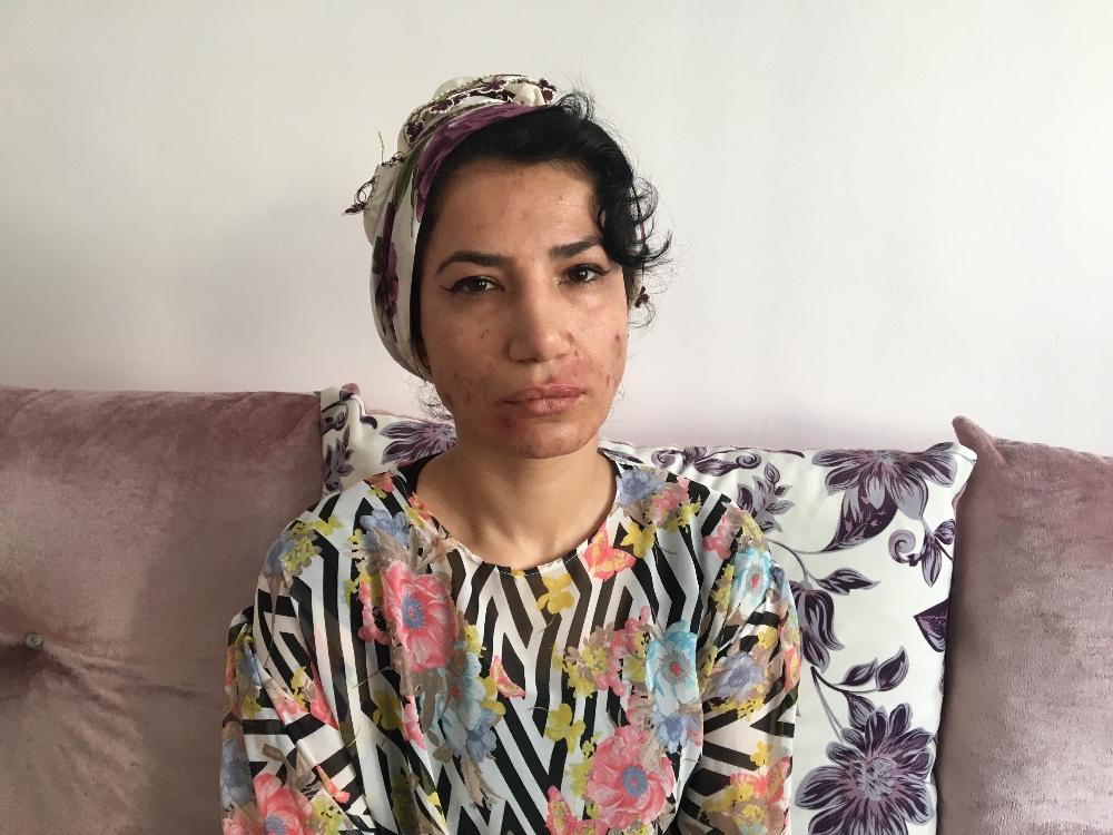 Burun estetiği kabusu oldu