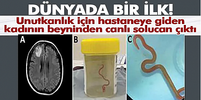Dünyada ilk: Avustralya'da bir hastanın beyninden canlı solucan çıkarıldı