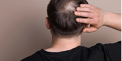 Erkeklere müjde.. Kelliğin ilacı bulundu