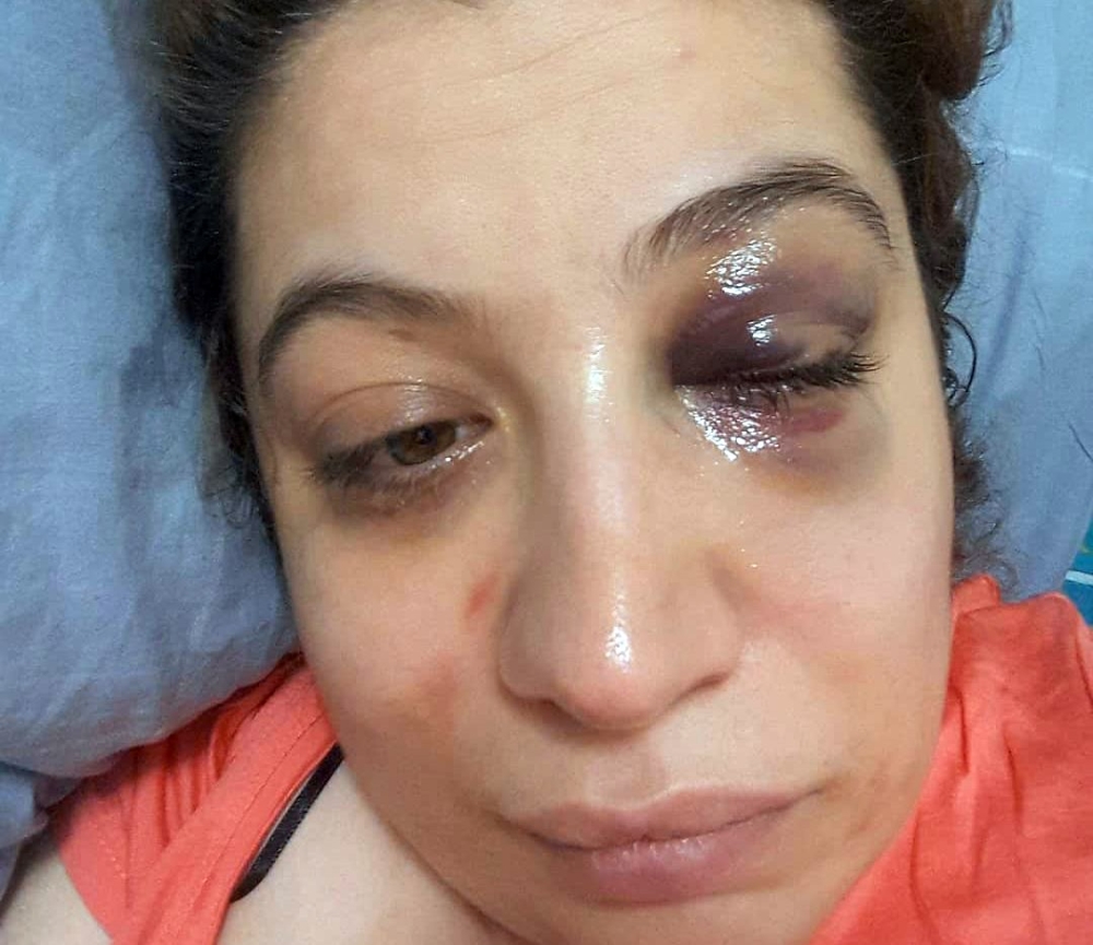 Eski eşi tarafından darp edilen kadın suç duyurusunda bulundu
