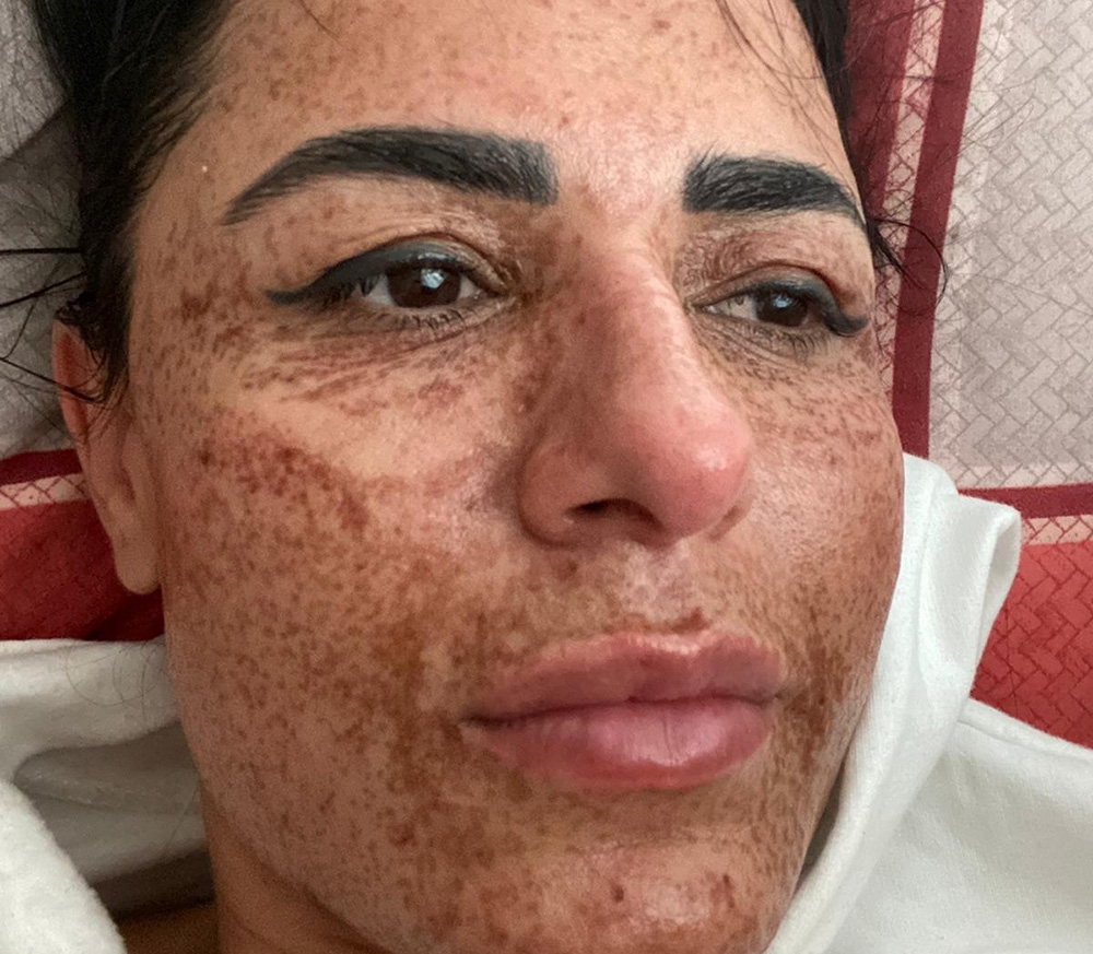 Güzelleşmek isterken yüzünde yanıklar oluştu