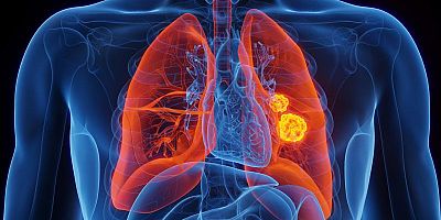İleri evre akciğer kanserinde 