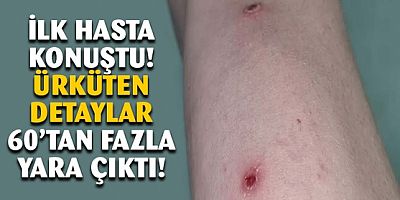 İlk maymun çiçeği hastası anlattı: 60'dan fazla yara saydım