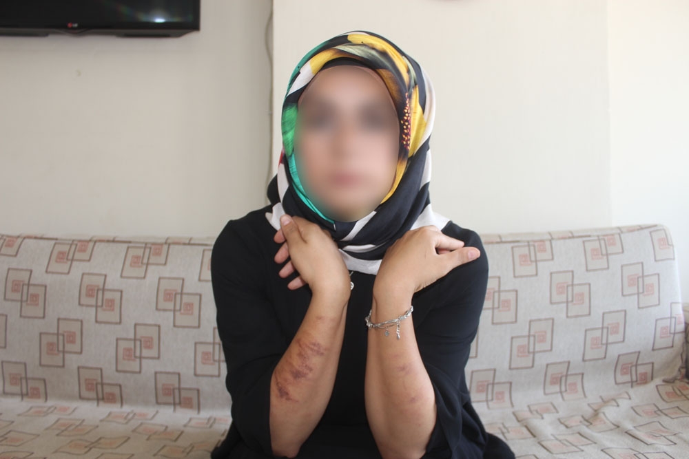 Lazer genç kadının vücudunu yaktı