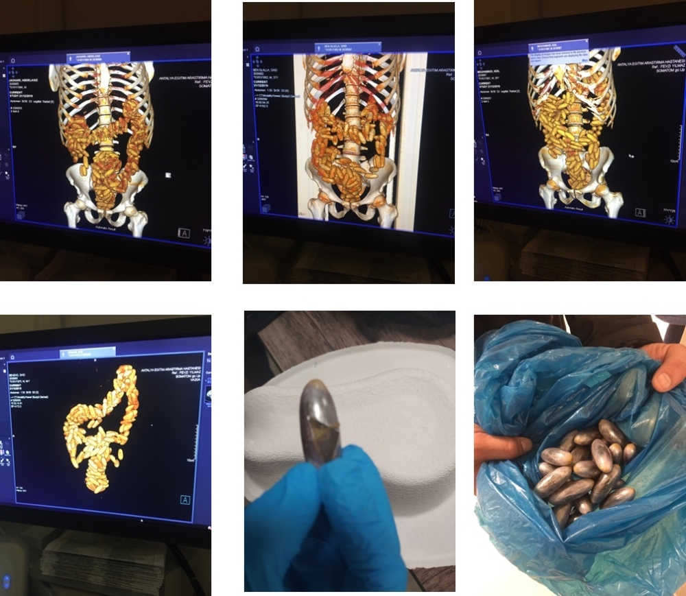 Şüphe Üzerine Çekilen Tomografi Gerçeği Ortaya Çıkardı