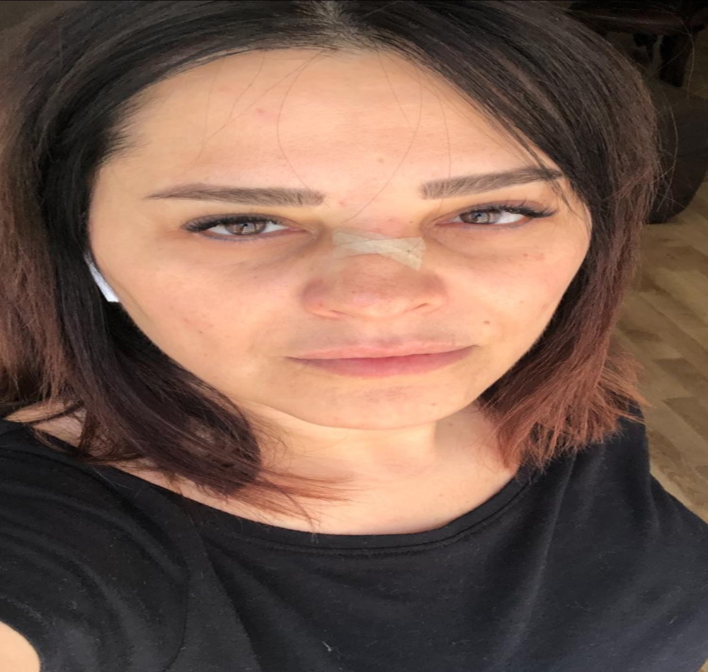 Ünlü şarkıcı Reyhan Karaca’nın burnu kırıldı