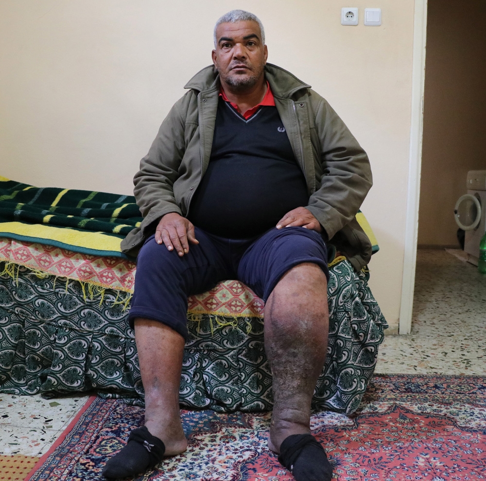 Varis Ameliyatı Oldu, Fil Hastası Çıktı