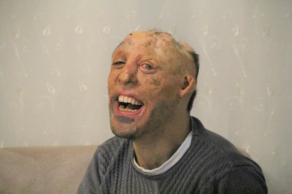 Vücudu Yanan Mehmet Alinin Dramı