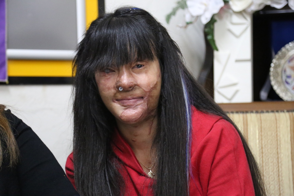 Yüzü Asitle Yakılan Berfin: Çektiğimiz Bir İki Yıla Sığacak Acı Değil